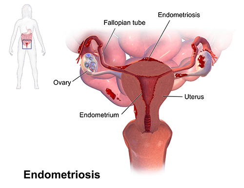 an illustration of Endometriosis